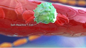 Updates in Diagnosing and Treating CIDP