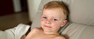 Pediatric Skin Disorders