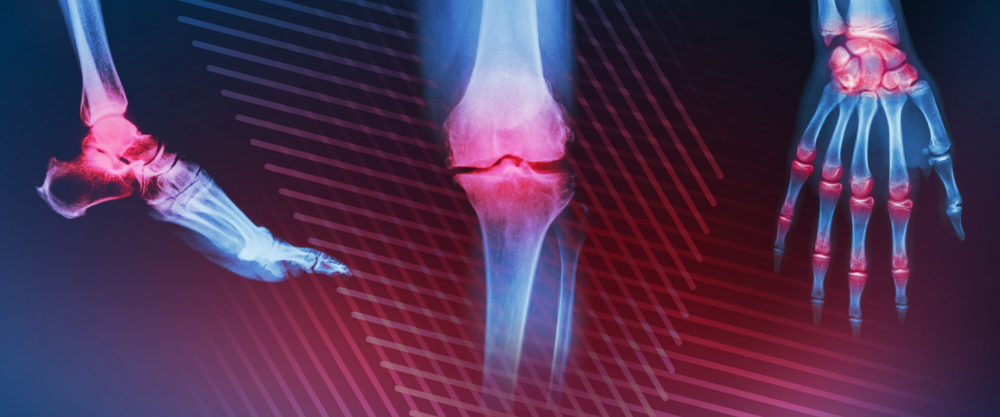 19th Annual Perspectives in Rheumatic Diseases (PRD) Conference