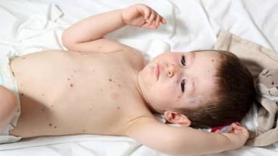 Pediatric Dermatology - Identify and Diagnose Concerning Presentations