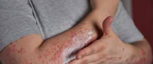 Systemic Lupus Erythematosus
